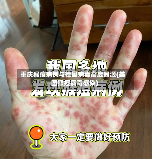 重庆猴痘病例与德国病毒高度同源(美国猴痘病毒感染)-第2张图片